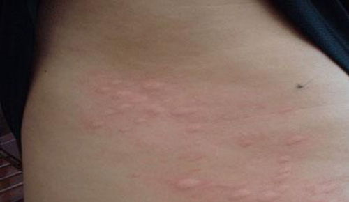 荨麻疹图片和症状 荨麻疹治疗方法有哪些