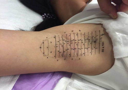 miradry微波治疗腋臭及腋下多汗 转载