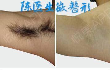 微创治疗狐臭 悦美整形
