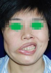 重庆治疗面瘫的最好办法