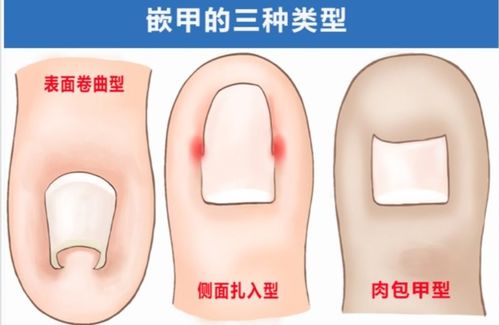 重庆市北碚区哪儿可以治甲沟炎