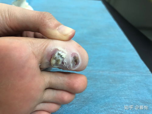 6年老跖疣新跖疣治疗过程,给各位病友借鉴 有图