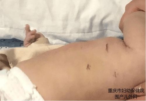 产前 产时 产后 全流程管理救治肺隔离征,重庆市妇幼保健院建立胎儿发育异常一体化诊疗新模式