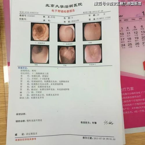成功逆转萎缩性胃炎 肠化 异型增生案例分享 西安五潮中医医院